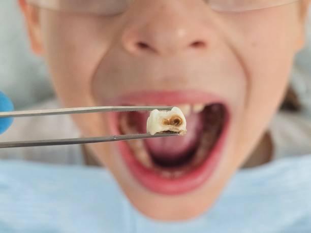 Best Emergency Wisdom Teeth Removal in Bald Kno, AR